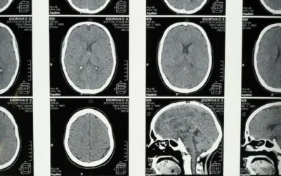 Can You Live A Normal Life After Brain Injury?