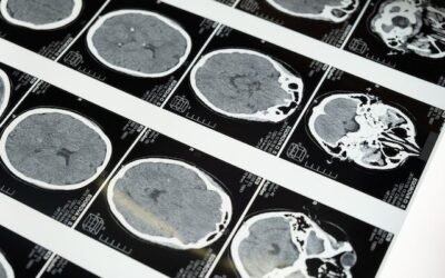 What Are The 3 Main Types Of Head Injury