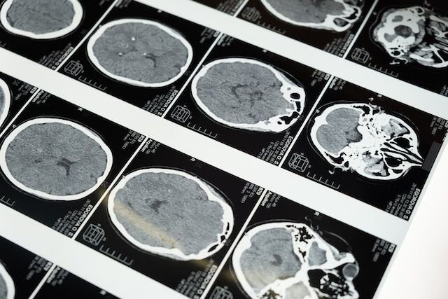 Orland Park Traumatic Brain Injury (TBI) Attorney - Michael J. Brennan