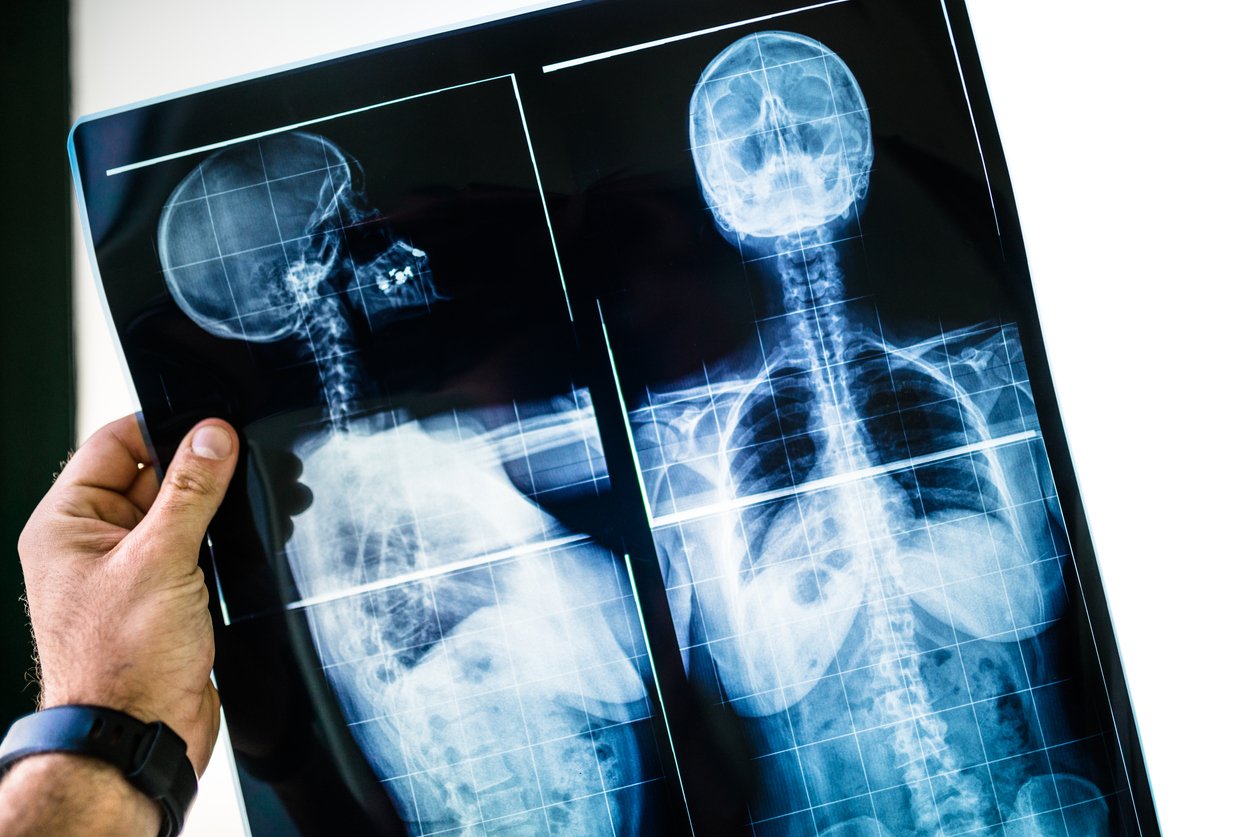 Spinal Cord Injury Lawyer in Orland Park, IL - Michael J. Brennan